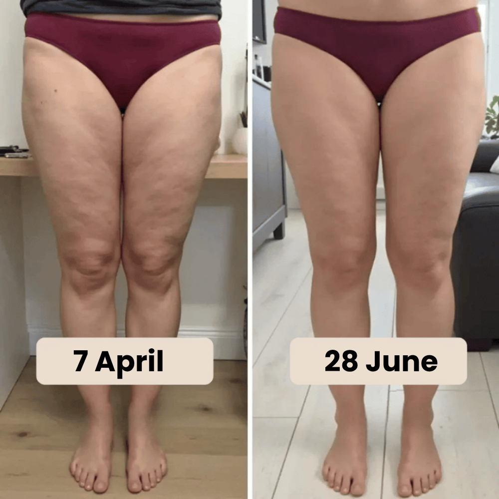 Cellumove 3D Legging – Say goodbye to lipoedema pain and swelling naturally